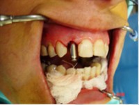 /album/galeria-de-fotos-carga-imediata-apos-exodontia-atraumatica-/carga-imediata-com-exodontia-atraumatica6-jpg/